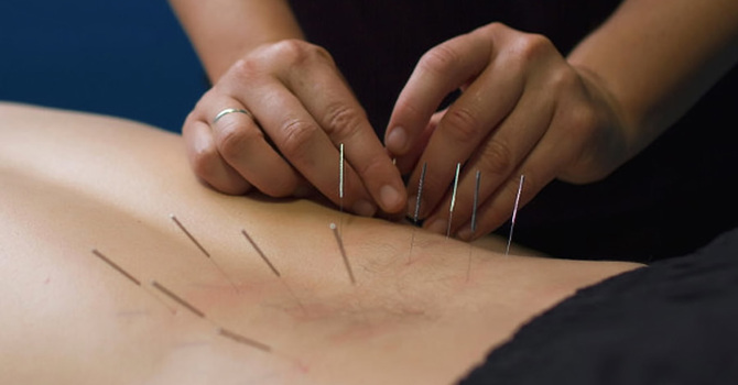 Dry Needling